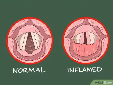 Imagen titulada Know if You Have Laryngitis Step 14