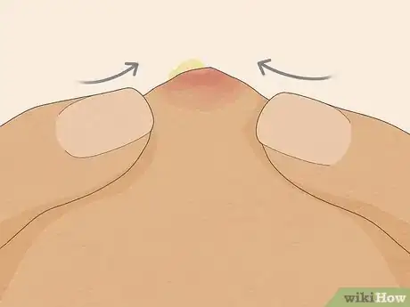 Imagen titulada Pop a Pimple Step 15