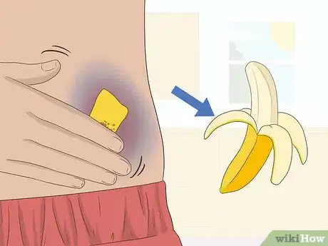 Imagen titulada Make a Bruise Go Away Faster Step 17