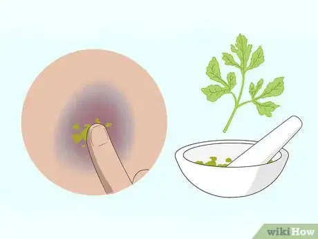Imagen titulada Make a Bruise Go Away Faster Step 11