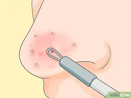 Imagen titulada Prevent Blackheads Step 10
