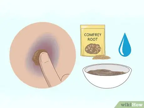 Imagen titulada Make a Bruise Go Away Faster Step 14