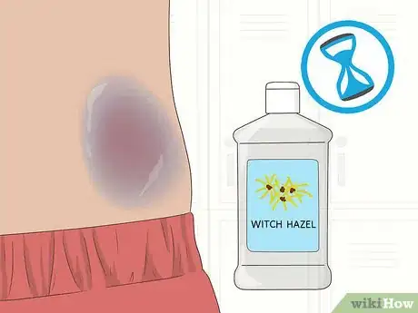 Imagen titulada Make a Bruise Go Away Faster Step 15