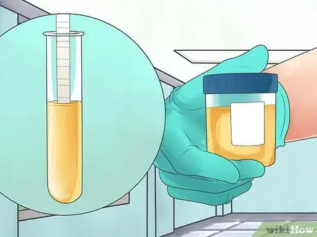 Imagen titulada Test for Kidney Disease Step 3