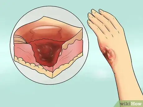 Imagen titulada Treat Minor Burns Step 3