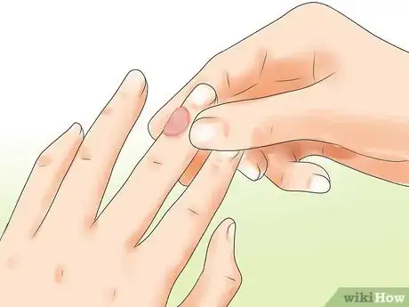 Imagen titulada Make a Huge Blister Heal Step 2