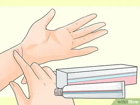Imagen titulada Cure Scabies Step 11
