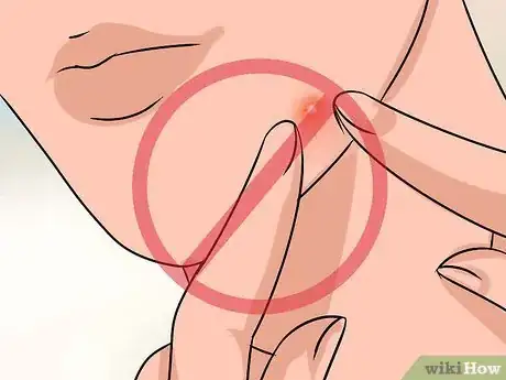 Imagen titulada Fade Acne Scars Step 19