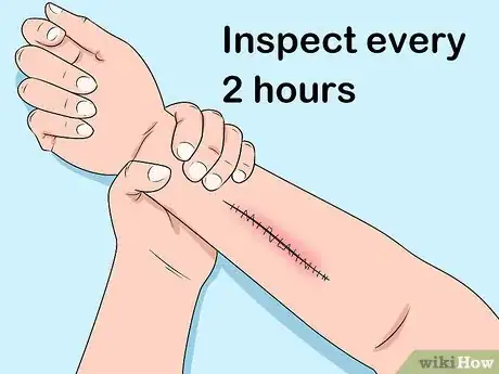 Imagen titulada Prevent Cellulitis Step 15