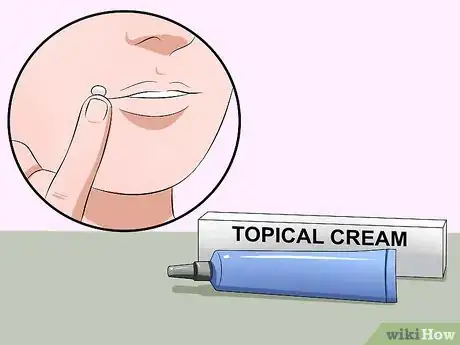 Imagen titulada Heal Cold Sores Step 10