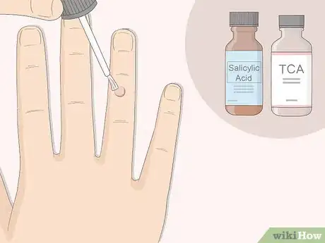 Imagen titulada Get Rid of Warts Step 2