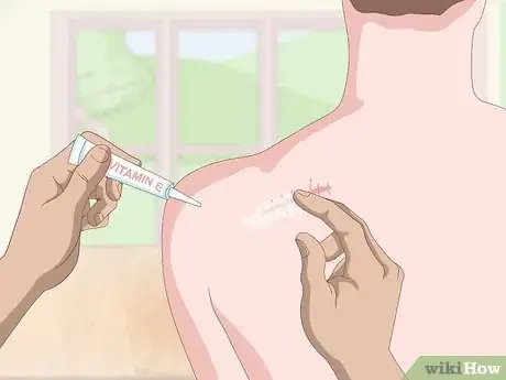 Imagen titulada Get Rid of Scars Step 3