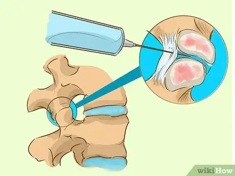 Imagen titulada Get Rid of a Nerve Pinch in Your Neck Quickly Step 8