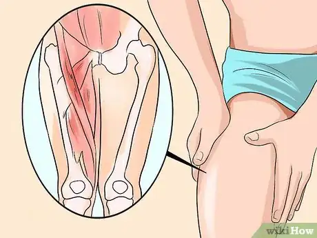 Imagen titulada Know if You Have a Hernia Step 23