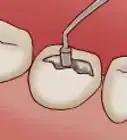 enderezar tus dientes sin frenillos