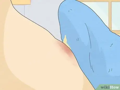 Imagen titulada Pop a Pimple Step 21