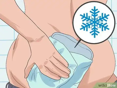 Imagen titulada Stop Bleeding Hemorrhoids Step 2