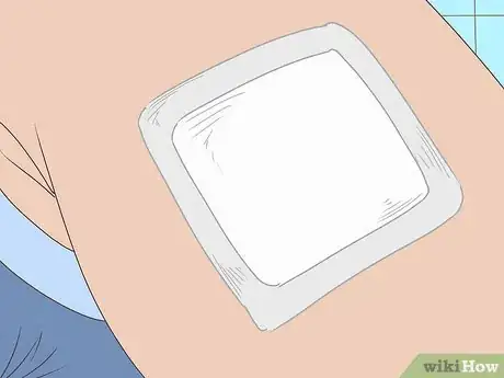 Imagen titulada Drain a Cyst Step 14