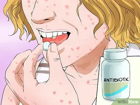 Imagen titulada Treat Chicken Pox Scars Step 9