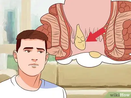 Imagen titulada Tell Signs of Sexual Infection from Penis Step 19