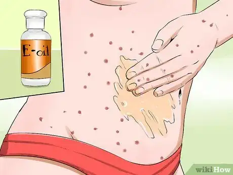 Imagen titulada Treat Chicken Pox Scars Step 6