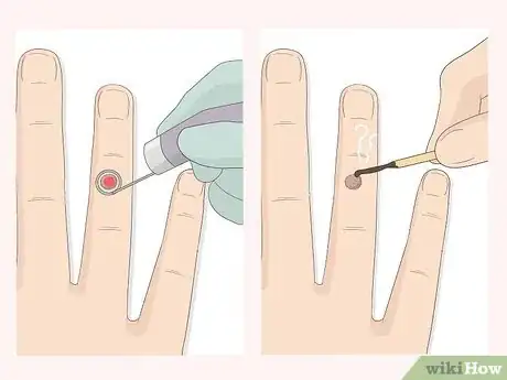 Imagen titulada Get Rid of Warts Step 6