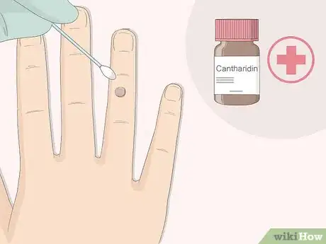 Imagen titulada Get Rid of Warts Step 4