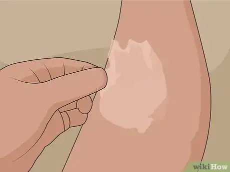Imagen titulada Remove Scars on Legs Step 17