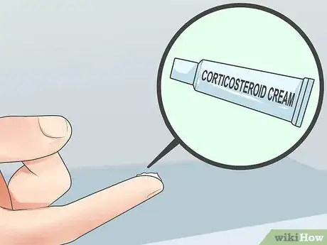 Imagen titulada Diagnose Psoriasis Step 11