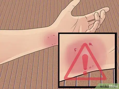 Imagen titulada Treat a Cat Bite Step 11