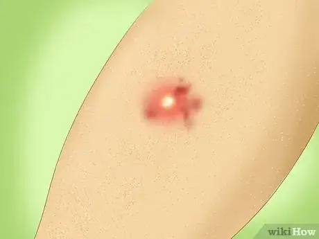 Imagen titulada Treat a Staph Infection Step 1