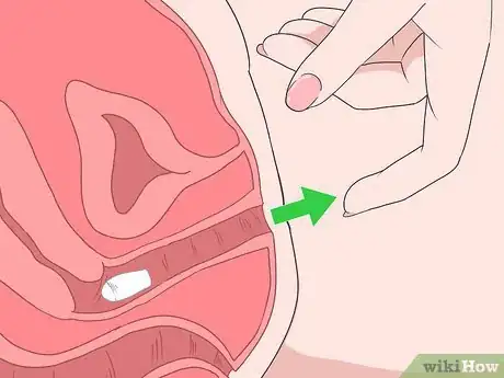 Imagen titulada Insert Progesterone Suppositories Without an Applicator Step 7