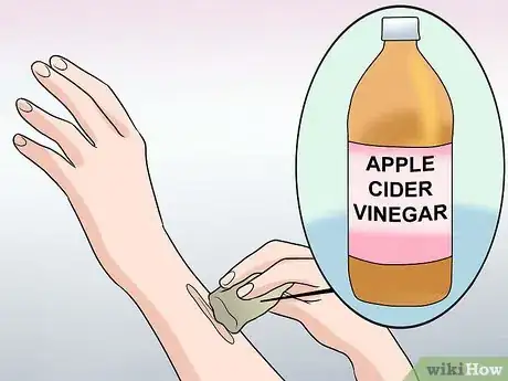 Imagen titulada Remove Keloid Scars at Home Step 12