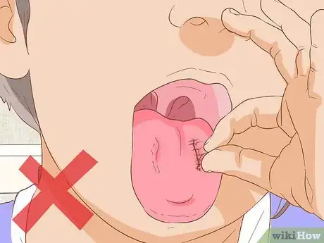 Imagen titulada Stop Tongue Bleeding Step 15
