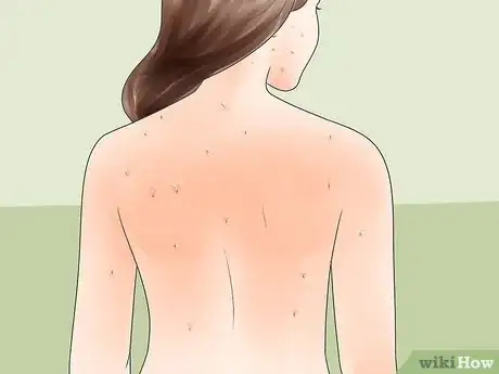 Imagen titulada Diagnose Measles Step 4
