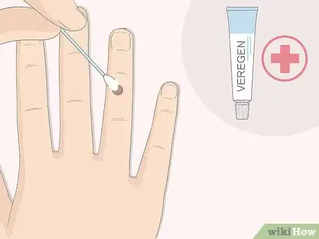 Imagen titulada Get Rid of Warts Step 9