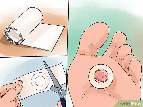 Imagen titulada Heal Blisters Step 3