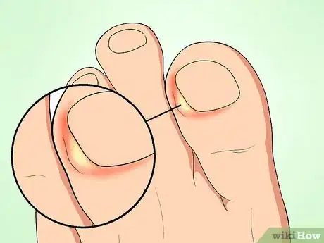Imagen titulada Tell if an Ingrown Toenail Is Infected Step 3