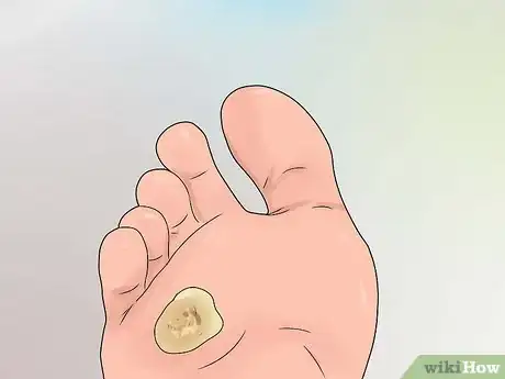 Imagen titulada Treat a Corn or Callus Step 12