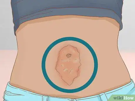 Imagen titulada Clean Your Belly Button Step 6
