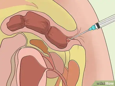 Imagen titulada Stop Bleeding Hemorrhoids Step 9