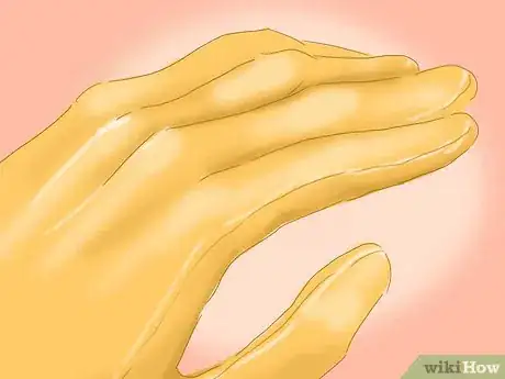 Imagen titulada Treat Raw Blisters on the Palm of Your Hand Step 8