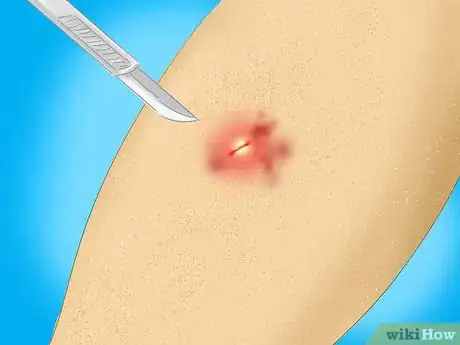 Imagen titulada Treat a Staph Infection Step 5