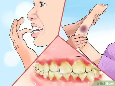 Imagen titulada Diagnose and Treat Scurvy Step 2