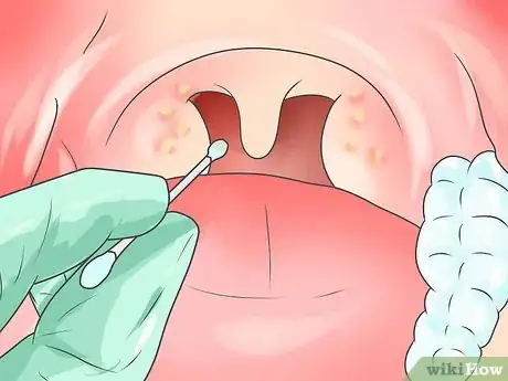 Imagen titulada Take a Throat Culture Step 6