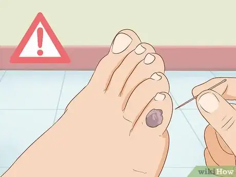 Imagen titulada Treat a Blood Blister Step 8