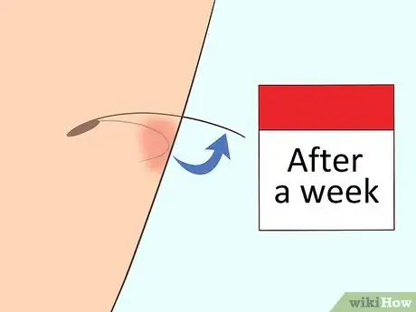 Imagen titulada Remove an Ingrown Hair Step 1