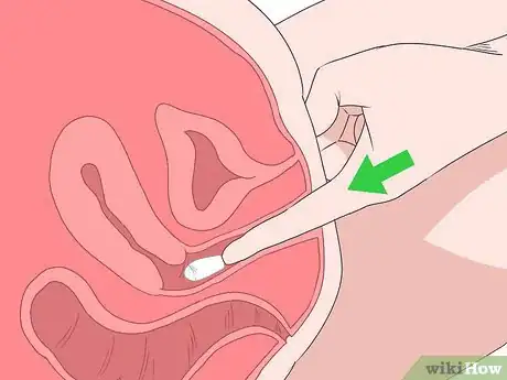 Imagen titulada Insert Progesterone Suppositories Without an Applicator Step 6