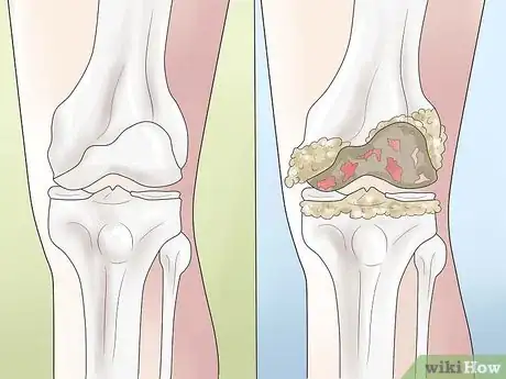 Imagen titulada Know if You Have a Baker's Cyst Step 10