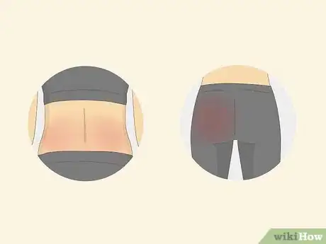 Imagen titulada Tell if Back Pain Is Due to a Muscle or Disc Step 1